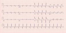 Image result for icd 10 code for acute myocardial infarction anterior wall