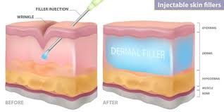 Image result for Dermal Filler Injection