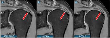 Image result for Shoulder MRI