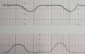 Image result for Variable Deceleration