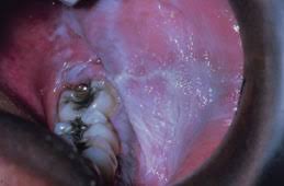 Image result for Leukoedema