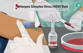 Image result for Herpes Simplex Virus Testing