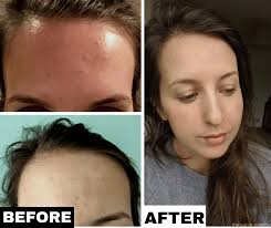 How I Cleared My Tiny Bumps On Forehead Once For All Forehead Bumps Forehead Acne Little Bumps On Forehead