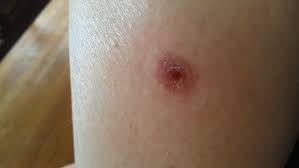 Printing layers of skin to help treat chronic wounds or burns may be on the horizon, thanks to. Healing Update My Cancer Month