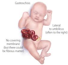 A human body consists of roughly 79 organs, discovered to date. Facts About Gastroschisis Cdc