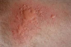 Food Allergies Clinical Advisor