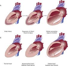Cardiac remodeling is a term that refers to changes in the heart's size and shape that occur in response to cardiac disease or cardiac damage. Severe Heart Failure Anesthesia Key