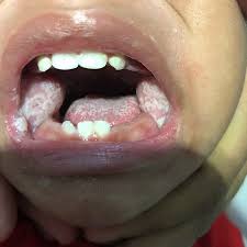 Sariawan utawa stomatitis ya iku radang kang kadadéan ing mukosa mulut, lumrahé wujud bercak putih rada kekuningan. Ciri Ciri Sariawan Pada Bayi Ini Bedanya Sariawan Dan Jamur Mulut