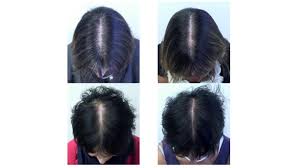 The link between low estrogen and hair loss can also be noticed in women who are being treated for cancer, when their ovarian function is destroyed and when their ovaries are removed. Nutritional Supplement Shown To Be Effective In Reducing Female Hair Loss