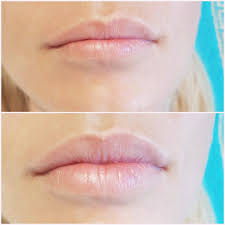 On je u emisiji hit tvit otvoreno pokazao kakvu povredu je dobio od svoje partnerke. Sve Sto Treba Da Znate O Povecanju Usana Sito Reseto