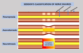 Classification of nerve injury was first described by seddon in 1943 and then expanded by sunderland in 1951. Peripheral Nerve Injury Classification Wikipedia