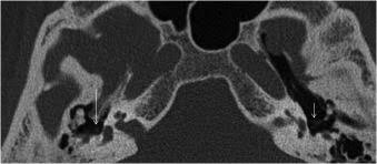 Image result for Myringosclerosis