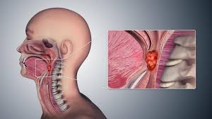 Each subtype of throat cancer has its own criteria for each stage. Throat Cancer Symptoms Pictures Causes And Treatment