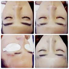 Once your initial brows have healed (up to 8 weeks), and you have the green light to have them corrected, brittany will decide if a saline/laser removal is necessary or the previous work is something she can work around. Eyebrow Tattoo Removal Microblading Removal At Redeem Laser Clinics