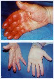 Incidence And Clinical Consequence Of The Purple Glove Syndrome In Patients Receiving Intravenous Phenytoin Neurology