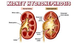 Pin By Richard Morring On Kidney S In 2020 Kidney Disease Kidney Kidney Disease Diet