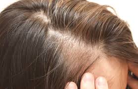 Unfortunately, society has forced women to suffer in silence. Hair Loss In Women And How Keralase Can Help Vanish Inc