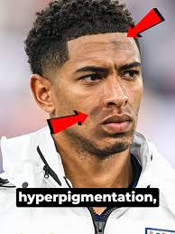 Understanding Bellingham's Face Condition: Hyperpigmentation Explained