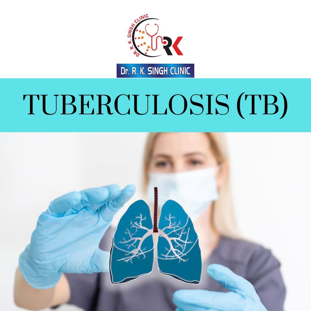 Tuberculosis (TB) – Expert Diagnosis & Treatment product image
