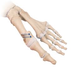Check spelling or type a new query. Arthrex Chevron Osteotomie