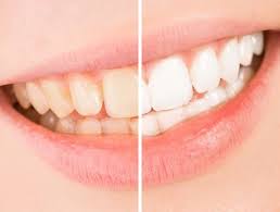 Blanchiment Des Dents Indications Techniques Prix Doctissimo