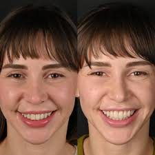 One single glass ceramic veneer Some bondings… She was like 'Emily in  Paris'💫💫💫 #cosmeticdentistry #estheticdentistry Ceramic material  @hassambassador_kr Amber press LT W4 Lab @konfordentall Ceramic work &  Clinic work @dr.nesrin_sonmez