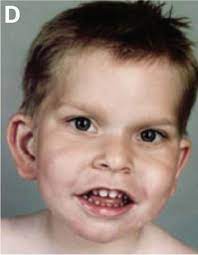 Forgotten Diseases Research Foundation Pitt Hopkins Syndrome Pths