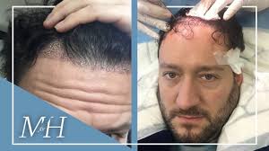 A hair transplant can be a permanent solution for hair loss, and is carried out with minimal surgical intervention. Hair Transplant Transformation Phil S Fue Surgery And Results Youtube