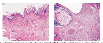 The comedones are widened openings for hair follicles and sebaceous glands filled with material. Figure 3 From Favre Racouchot Syndrome Associated With Eyelid Papilloma A Case Report Semantic Scholar