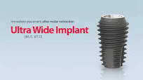 ULTRA WIDE IMPLANT - Hiossen's Implant Rescusing Failed Cases!
