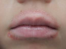There are a # of possible causes. What Is Perioral Dermatitis