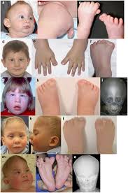 Metopic And Sagittal Synostosis In Greig Cephalopolysyndactyly Syndrome Five Cases With Intragenic Mutations Or Complete Deletions Of Gli3 European Journal Of Human Genetics