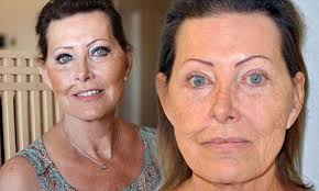 It affects people of all races, genders and ages, which is why it's absolutely critical for americans to learn about. My Face Was Wrecked By Skin Cancer But My Plastic Surgeon Left Me Looking 10 Years Younger Daily Mail Online