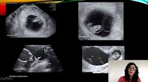 Read it all in this post about the lambda symbol, its meaning, history and uses. Black Lambda Sign Monochorionic Diamniotic Pregnancy Youtube