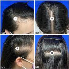 Thinning hair is a fact of life. Frontiers Female Pattern Hair Loss In Female And Male A Quantitative Trichoscopic Analysis In Chinese Han Patients Medicine