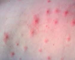 When hair follicles get damaged , they let in bacteria and get infected. Hot Tub Folliculitis Pictures Symptoms Diagnosis Treatment