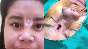 Hidung pendek lagi mancung in a sentence and translation of hidung pendek lagi mancung in english dictionary with audio pronunciation by dictionarist.com. Lakukan Ini Supaya Hidung Mancung Eh Yang Terjadi Malah Jelek Dan Mengerikan Banjarmasin Post