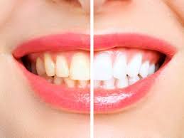 Kandungan antibakteri pada garam akan membunuh kuman yang menyebabkan gigi berlubang. 8 Cara Memutihkan Gigi Kuning Dengan Bahan Alami Indozone Id