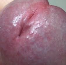 Par ce clair matin de mai 1940, l'armée française reculait, selon le. Boutons Douloureux Qui Reviennent Et Repartent Ds La Meme Journee Infections Sexuellement Transmissibles Forum Sante Doctissimo