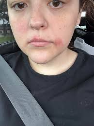 Burn after lip wax recommendations needed