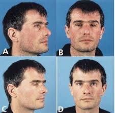 استعمال الثوم وعصير الليمون لعلاج القمل: Treatment Of Rosacea Like Demodicidosis With Oral Ivermectin And Topical Permethrin Cream Journal Of The American Academy Of Dermatology
