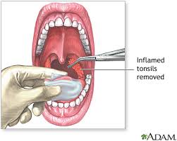 Image result for Tonsillectomy