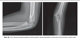 Image result for Coronoid Process Fracture