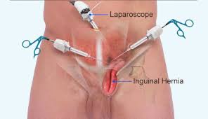 Laparoscopic hernia repair