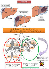 肝臓 膵臓 胆嚢の手術について Department りんくう総合医療センター 大阪府泉佐野市