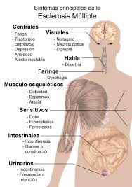 Los sintomas de la esclerosis múltiple incluyen síntomas variables, síntomas leves, cambios en la sensibilidad, variación de los síntomas, problemas de visión, incontinencia. El 70 De Los Afectados Por Esclerosis Multiple En Espana Son Mujeres Isanidad