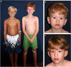 Prader Willi Syndrome European Journal Of Human Genetics