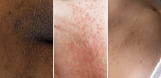 Image result for sweat rash on back baby