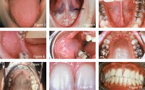 Image result for gums cancer symptoms