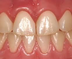 Red or swollen gums, especially on the side. Gum Disease Gingivitis Tepe Uk
